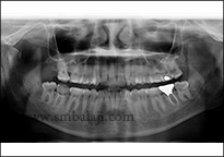 X-Ray Showing Fractured Right Condyle