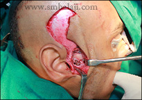 Right Condyle Fracture Stabilized Using Bone Plate