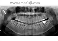 Post Operative X-Ray Showing Good Healing Of The Fractured Bone Segments