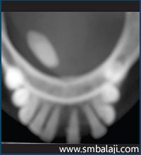 Occlusal Radiograph Of The Same Person Showing An Oblong Radiopacity Of The Calculus In The Right Side Of The Mandible