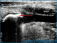 Ultrasound Showing The Presence Of Calculus In The Salivary Gland Ductd