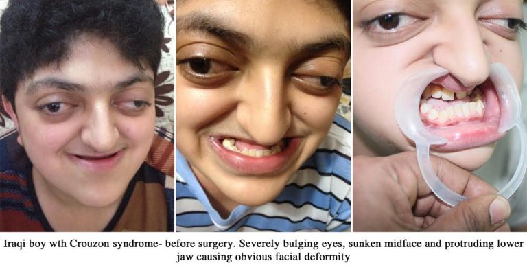 Crouzon Syndrome Treatment In India