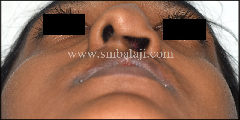 Depressed nose correction by closed rhinoplasty Balaji Dentla