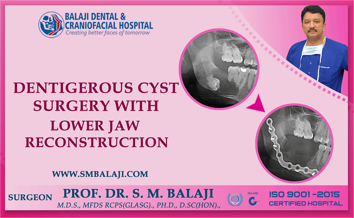 Dentigerous Cyst Surgery With Lower Jaw Reconstruction 8992