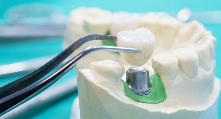 The Process Of Making Dental Crowns