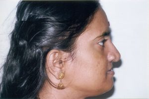 Upper Jaw Advancement And Improved Profile After Distraction