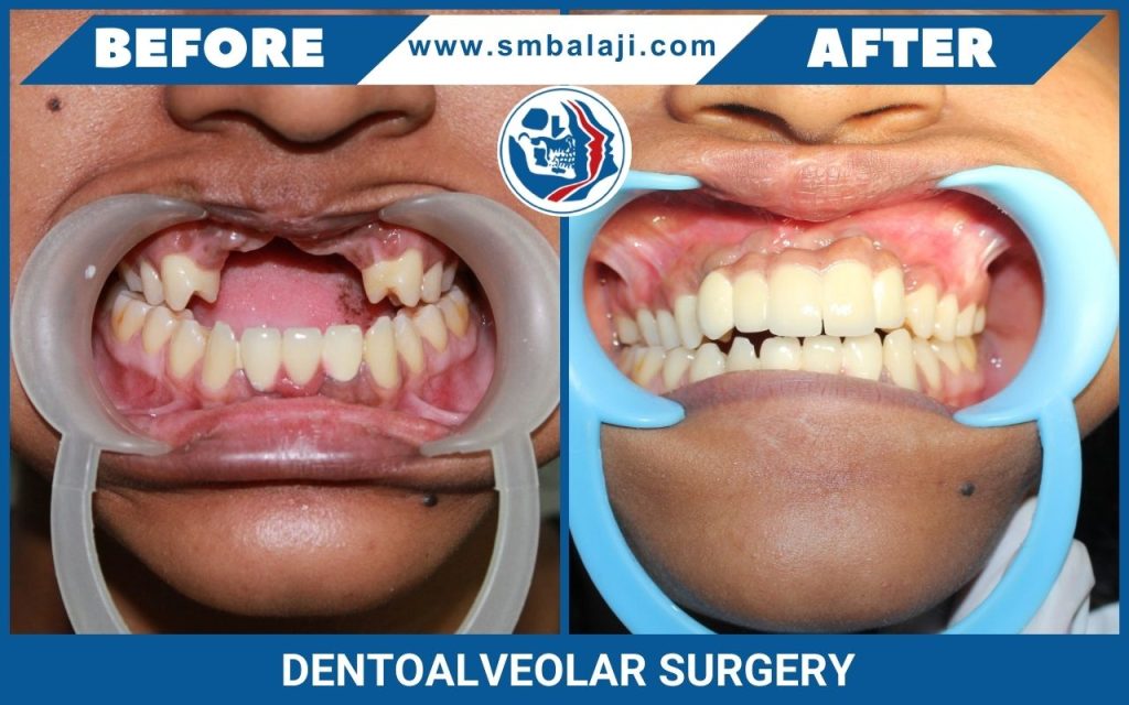 Dentoalveolar Surgery