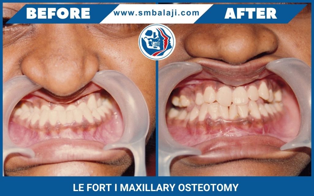 Le Fort Maxillary Osteotomy: Comprehensive Guide to Facial Correction ...