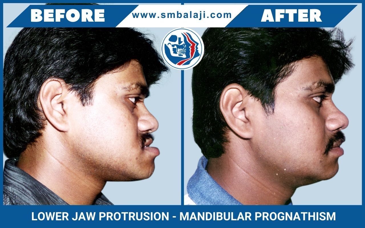 Mandibular Osteotomy: Restoring Jaw Alignment for Enhanced Facial Harmony