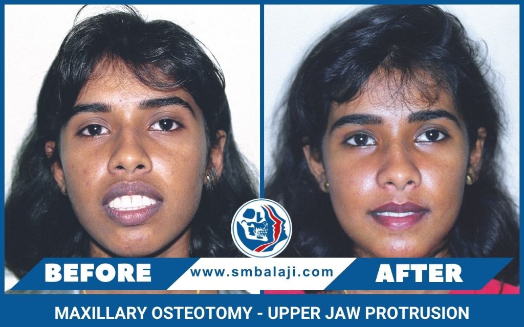 Maxillary Osteotomy - Upper Jaw Protrusion