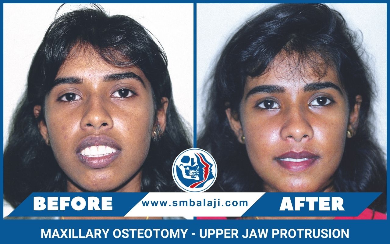 Maxillary Osteotomy, Upper Jaw Surgery, Orthognathic Surgery ...