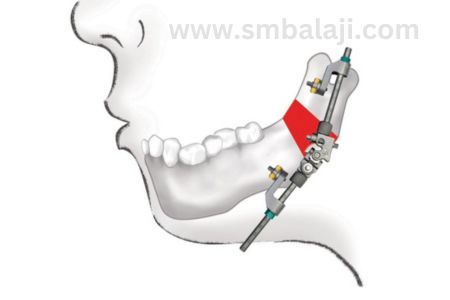 Mandibular External Pin Retained Multivector Distractor Placed In Lower Jaw