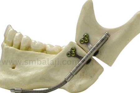 Mandibular Univector Internal Distractor With Rigid And Flexible Activation Arms Fixed To Lower Jaw Bone.