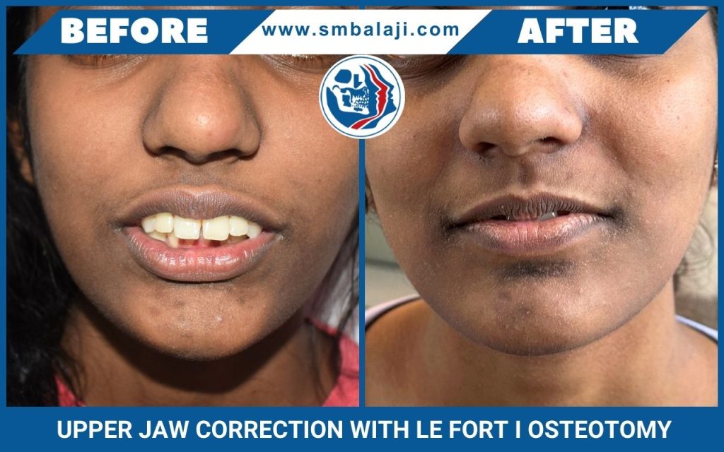 Upper Jaw Correction With Le Fort I Osteotomy