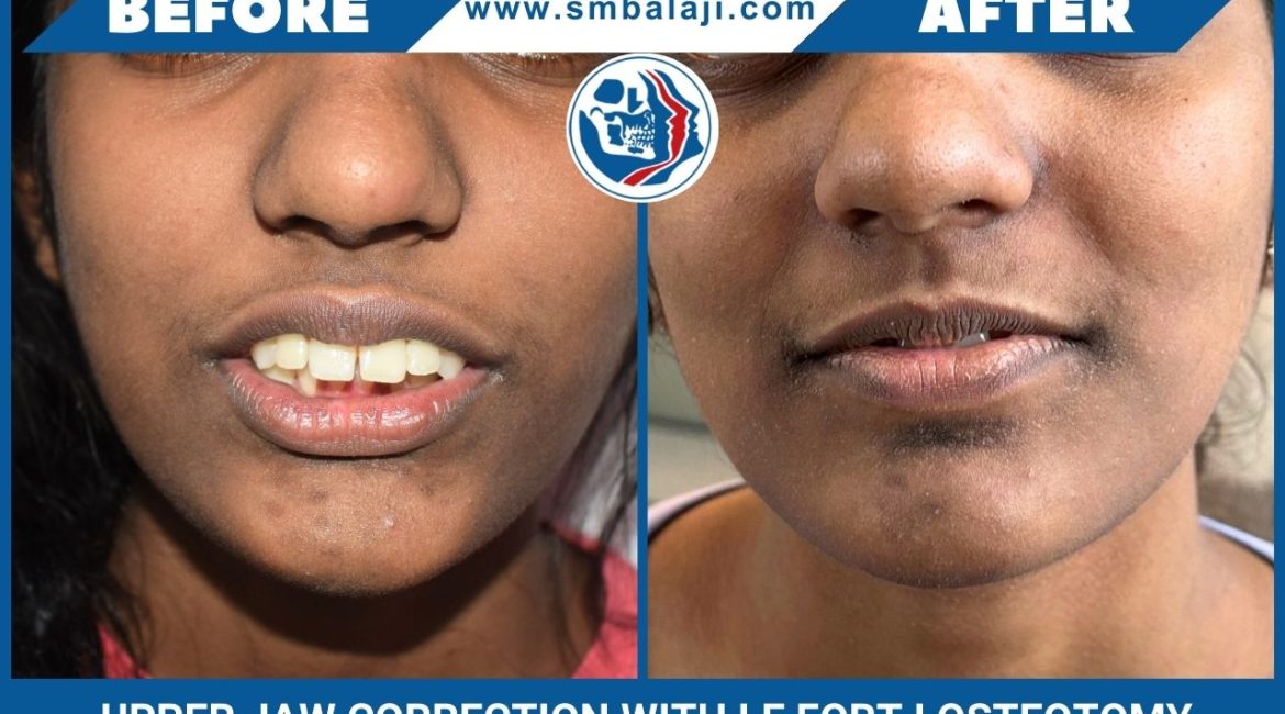 Upper Jaw Correction With Le Fort I Osteotomy