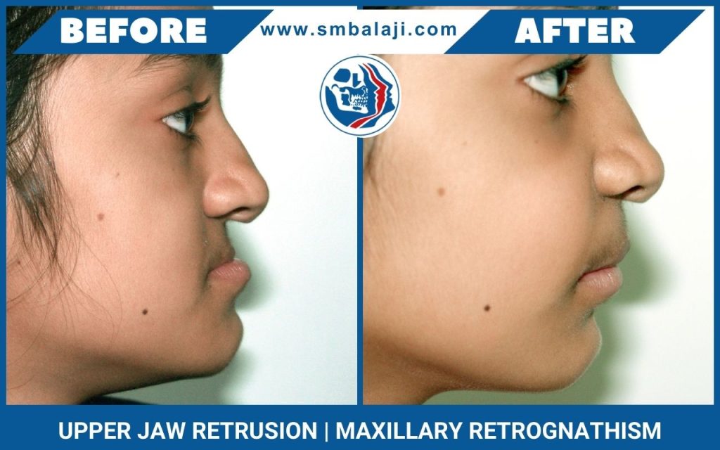 Upper Jaw Retrusion | Maxillary Retrognathism​