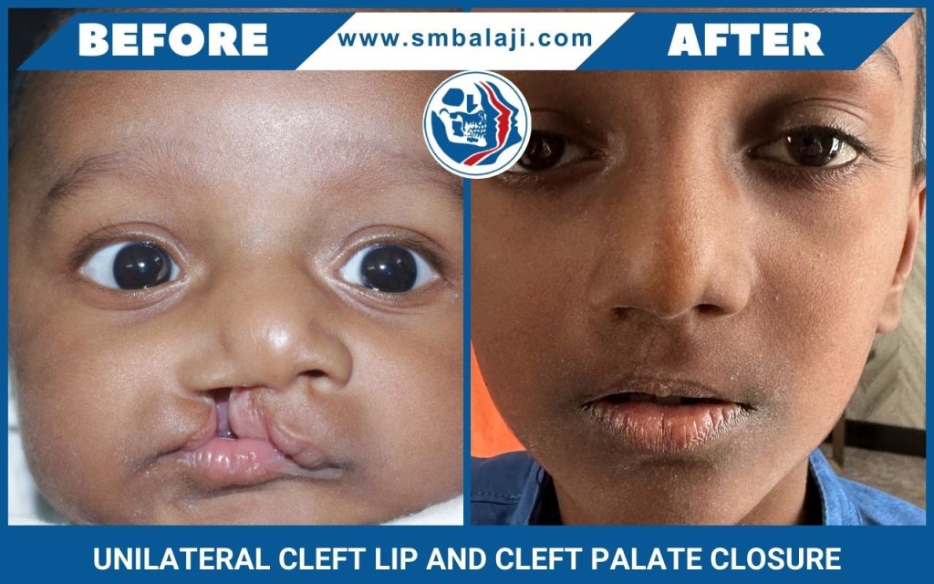 Unilateral Cleft Lip And Cleft Palate Closure