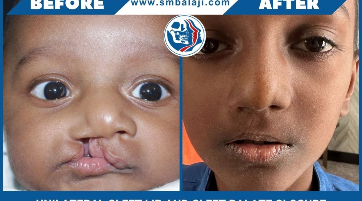 Unilateral Cleft Lip And Cleft Palate Closure