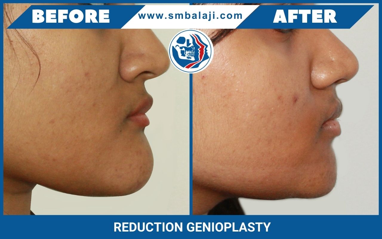 Genioplasty: Redefine Your Facial Contour with Chin Surgery