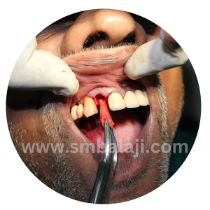 Exodontia Or Tooth Extraction