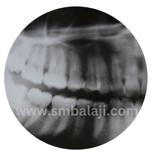 X-Ray Taken Before Extraction Of Upper Right Third Molar Tooth