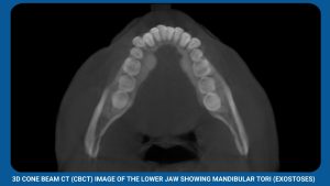 3D Cone Beam Ct (Cbct) Image Of The Lower Jaw Showing Mandibular Tori (Exostoses) (2)
