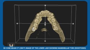 3D Cone Beam Ct (Cbct) Image Of The Lower Jaw Showing Mandibular Tori (Exostoses)