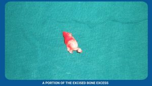 A Portion Of The Excised Bone Excess
