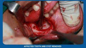 Affected Tooth And Cyst Removed