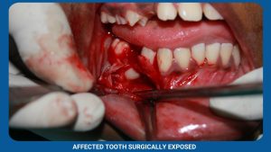 Affected Tooth Surgically Exposed