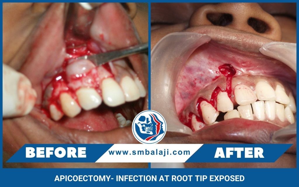 Apicoectomy- Infection At Root Tip Exposed