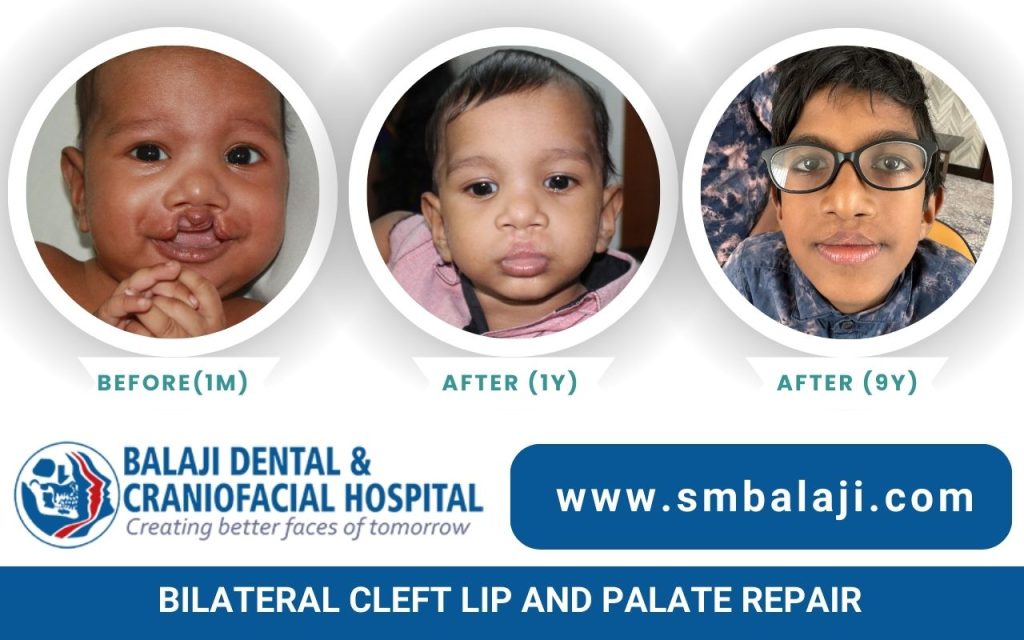 Bilateral Cleft Lip And Palate Repair