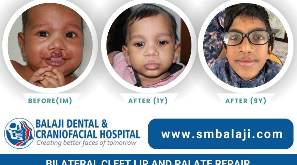 Bilateral Cleft Lip And Palate Repair