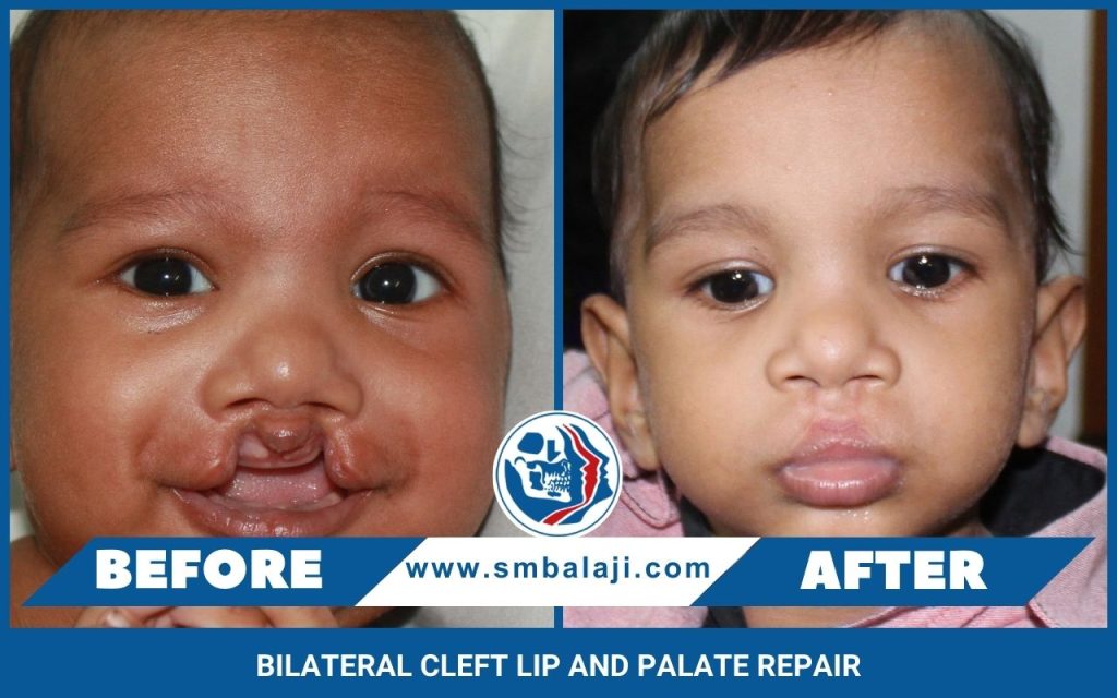 Bilateral Cleft Lip And Palate Repair