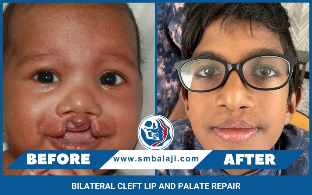 Bilateral Cleft Lip And Palate Repair