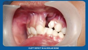 Cleft Defect In Alveolar Bone