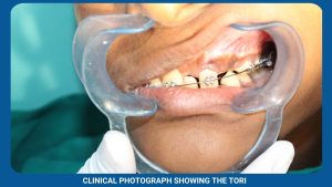 Clinical Photograph Showing The Tori