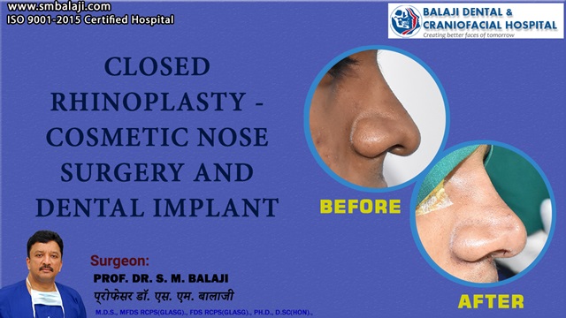 Closed Rhinoplasty - Cosmetic Nose Surgery And Dental Implant
