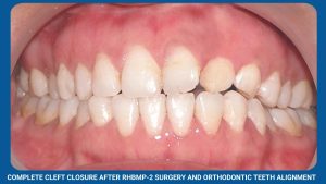 Complete Cleft Closure After Rhbmp-2 Surgery And Orthodontic Teeth Alignment