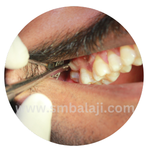 During Extraction- Accessing The Tooth From The Cheek Side