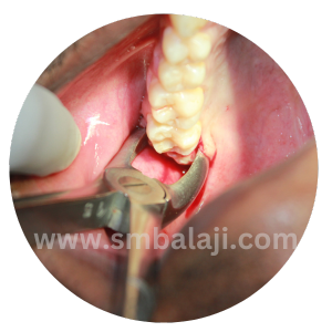 During Extraction- Grasping The Tooth With Forceps