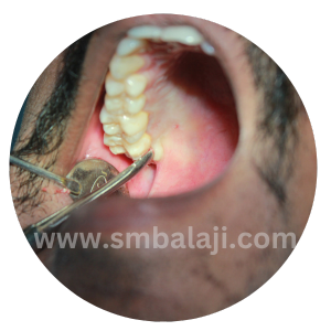 During Extraction- Accessing The Tooth From The Tongue Side