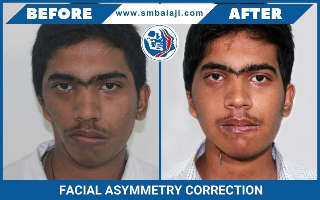 Facial Asymmetry Correction In India
