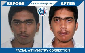 Facial Asymmetry Correction in India