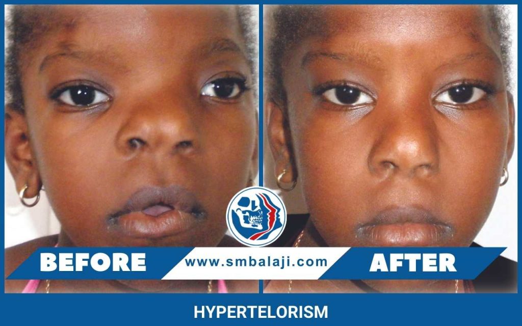 Hypertelorism Before And After Surgery