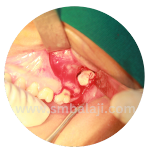 Left Tooth Surgically Exposed