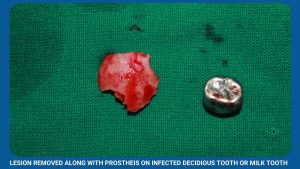 Lesion Removed Along With Prostheis On Infected Decidious Tooth Or Milk Tooth