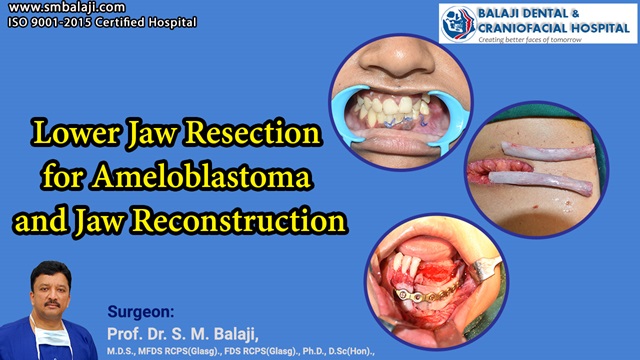 Lower Jaw Resection For Ameloblastoma And Jaw Reconstruction