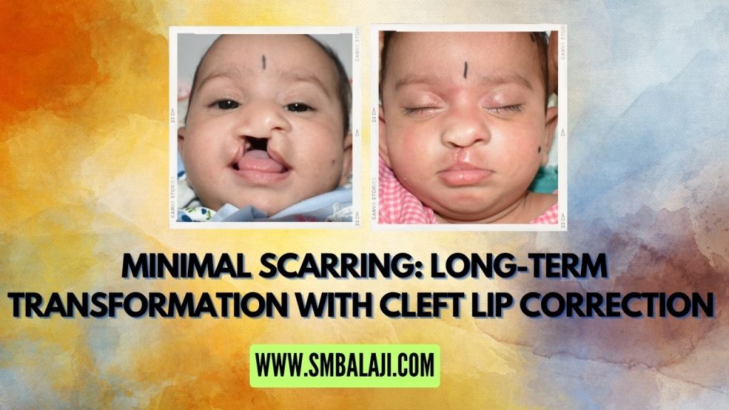 Long-Term Transformation With Cleft Lip Correction In India