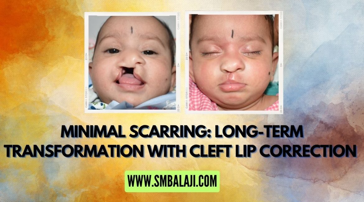 Long-Term Transformation With Cleft Lip Correction In India